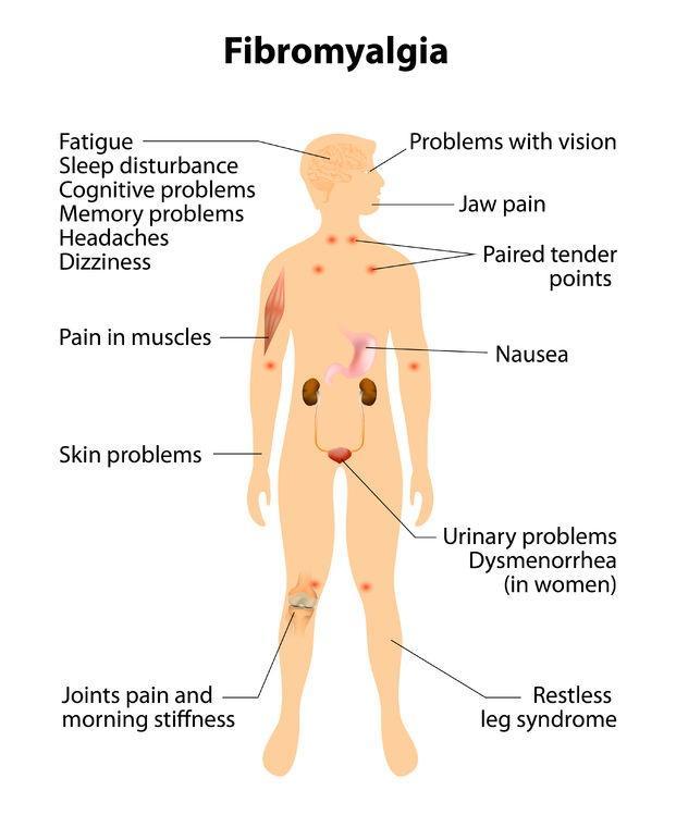 Fibromyalgia symptoms infographic